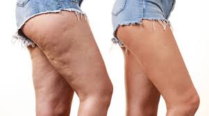 The Impact of Lipedema on Daily Life: Symptoms and Solutions